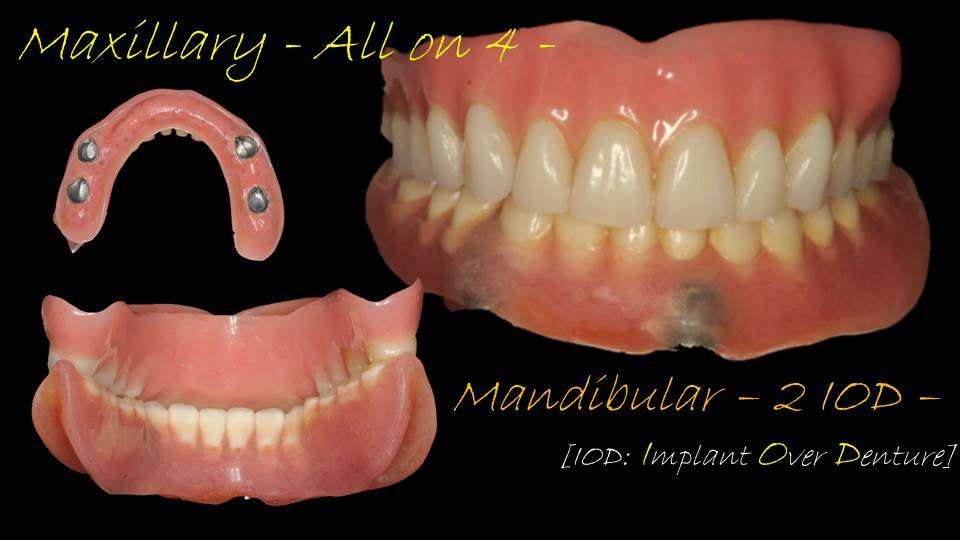 流山のグランツ歯科クリニックでは「インプラントオーバーデンチャー」や「All on 4」などのインプラントで支える入れ歯の治療が受けられます。