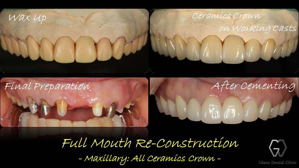 流山のグランツ歯科クリニックでは「虫歯や歯周病で歯がボロボロ」でもセラミックスを用いた全顎補綴治療が受けられます。