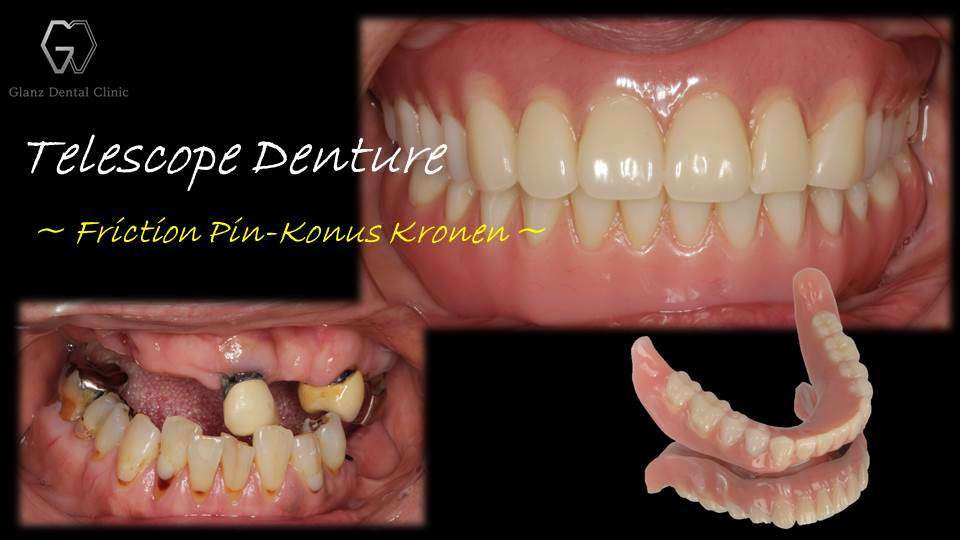流山のグランツ歯科クリニックでは「よく咬めて動かない、見た目が良くて、違和感が少ない」テレスコープ義歯の治療が受けられます。